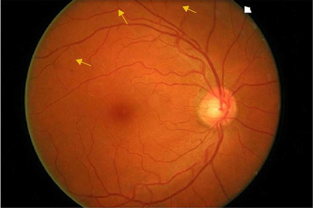 retinopatia diabetica no proliferativa severa