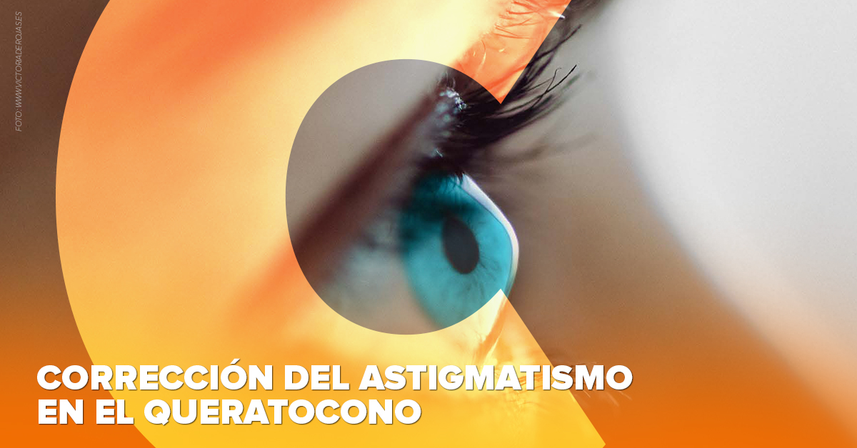 Corrección del astigmatismo en el queratocono
