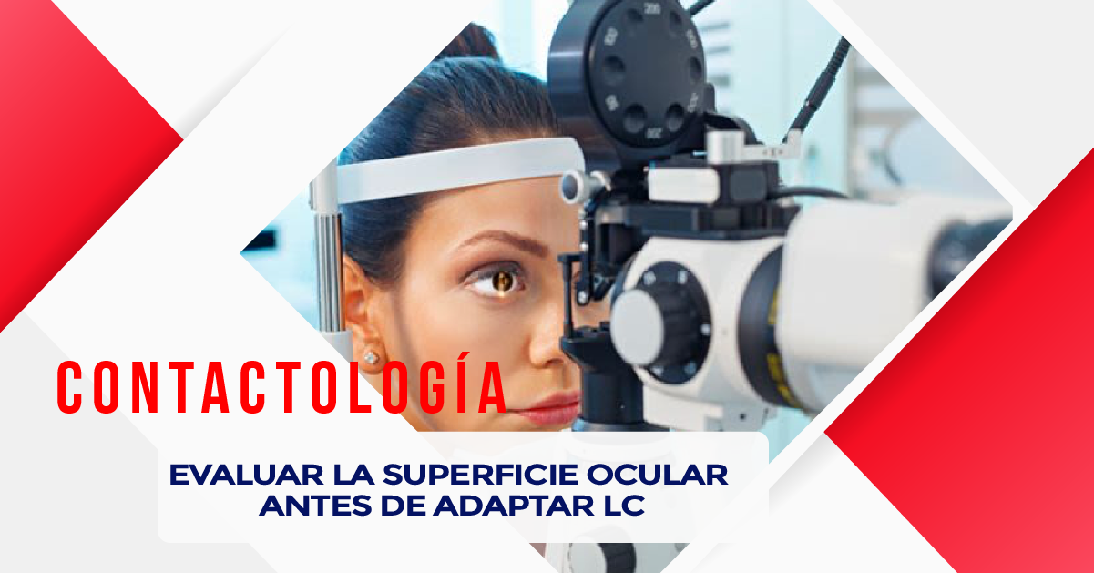 EVALUAR LA SUPERFICIE OCULAR ANTES DE ADAPTAR LC